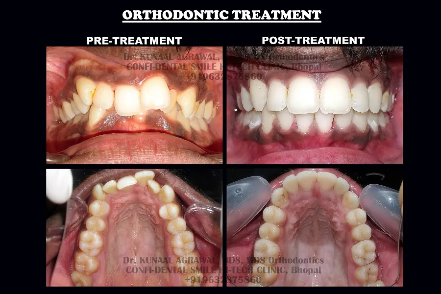 braces before and after bhopal 10